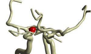 Polskie oprogramowanie wesprze neurochirurgów w leczeniu tętniaków